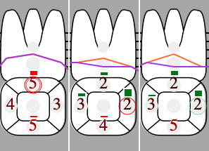 Veränderung Taschentiefen